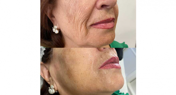 Microdermoabrasin + Radiofrecuencia Facial Antiedad en Clnicas DH Toledo